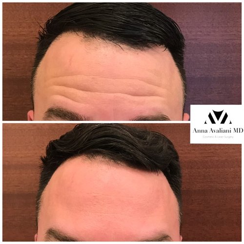 Botox Before and After - bbt9