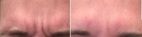 Botox Before and After - bot1