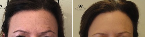 Botox Before and After - bot11