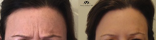 Botox Before and After - bot12