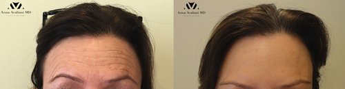 Botox Before and After - bot13
