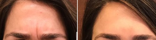 Botox Before and After - bot2