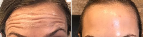 Botox Before and After - bot3