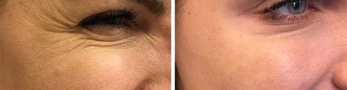 Botox Before and After - bot444