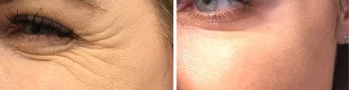 Botox Before and After - bot555