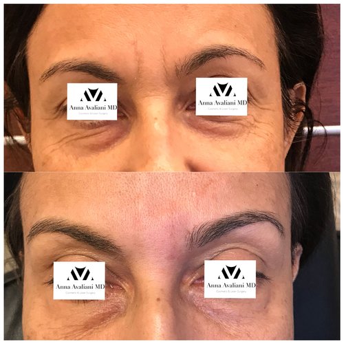 Botox Before and After - btx1