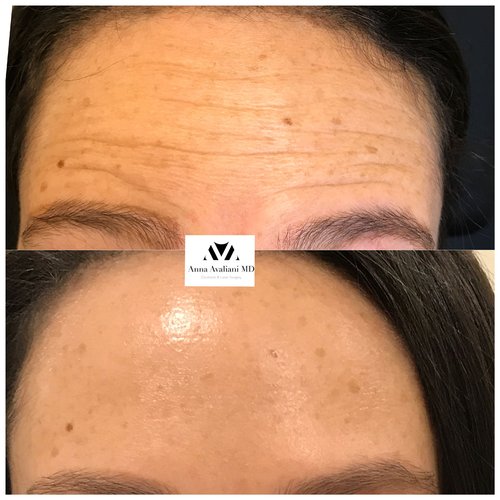 Botox Before and After - btx10