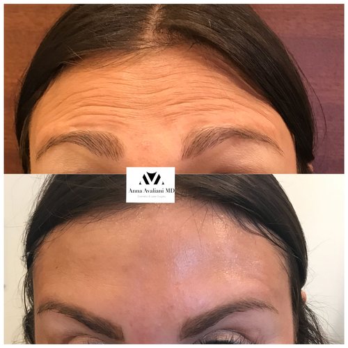 Botox Before and After - btx11