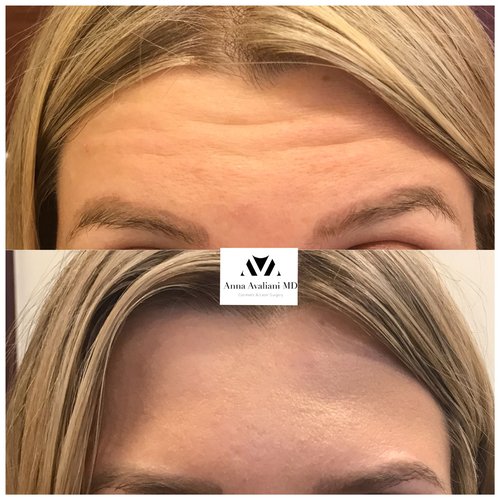 Botox Before and After - btx12