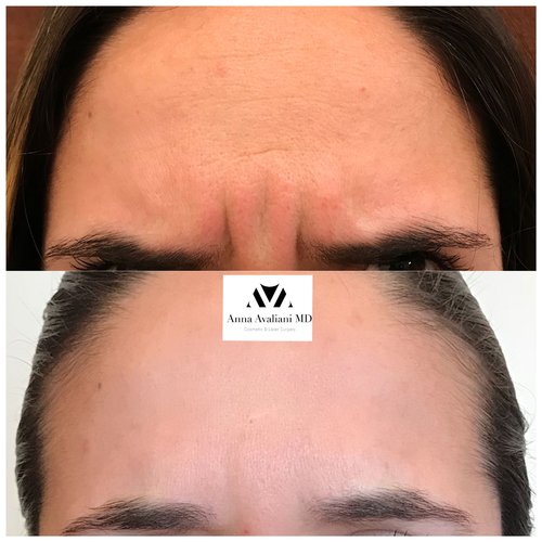 Botox Before and After - btx13