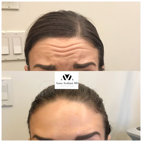 Botox Before and After - btx14