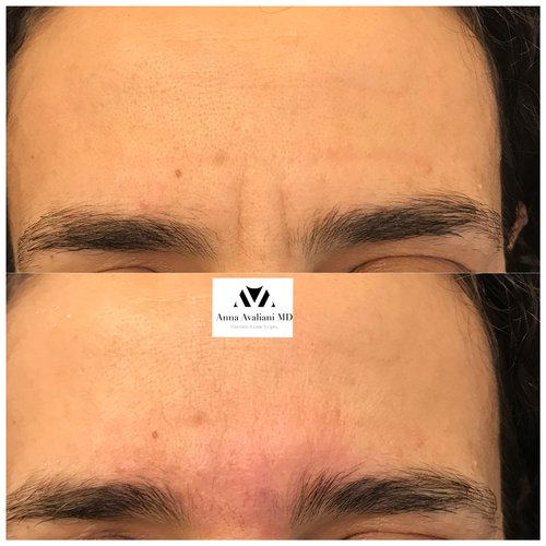 Botox Before and After - btx15