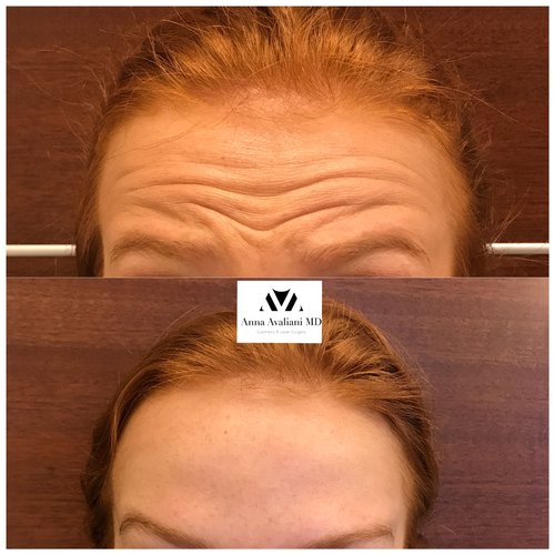 Botox Before and After - btx16