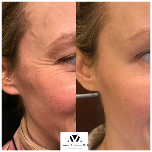 Botox Before and After - btx17