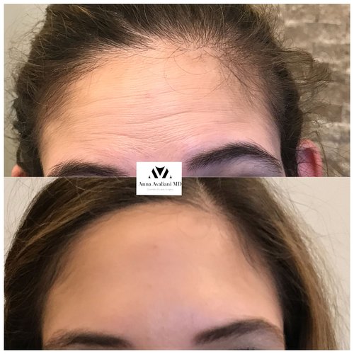 Botox Before and After - btx18