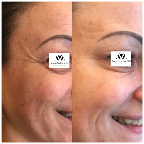 Botox Before and After - btx2