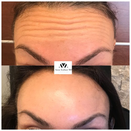 Botox Before and After - btx3