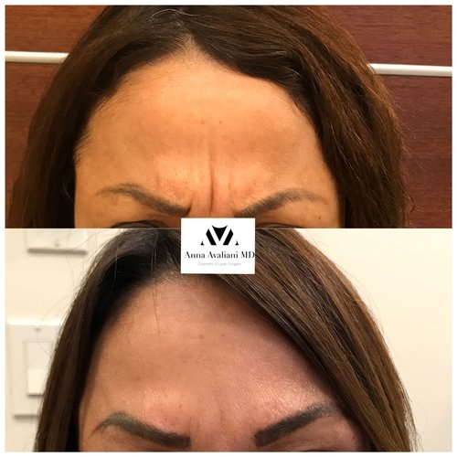 Botox Before and After - btx4