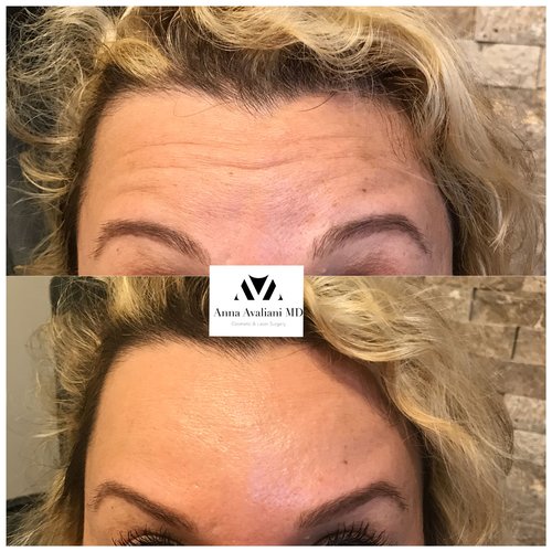 Botox Before and After - btx5