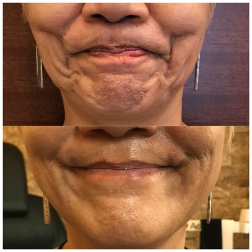 Botox Before and After - btx6