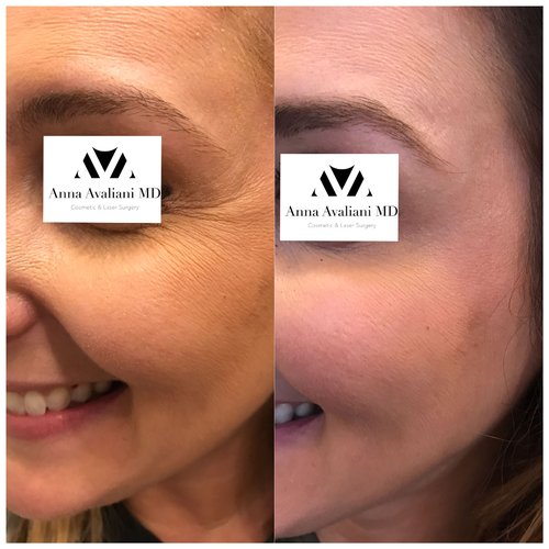 Botox Before and After - btx7