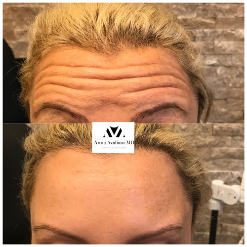 Botox Before and After - btx8