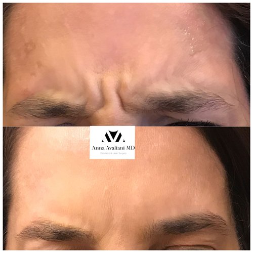 Botox Before and After - btx9