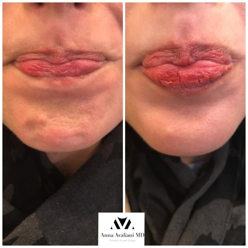 Botox Before and After - bx1