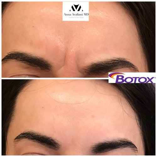 Botox Before and After - bx10