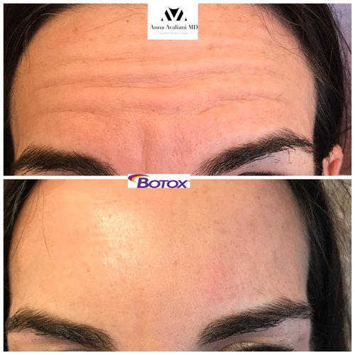 Botox Before and After - bx11