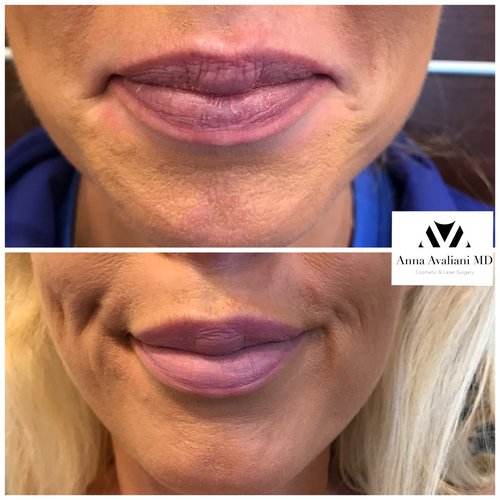Botox Before and After - bx12