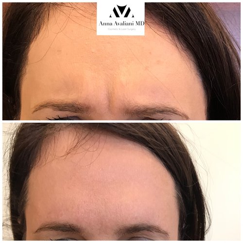Botox Before and After - bx13