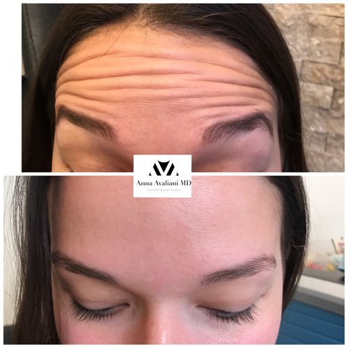 Botox Before and After - bx14