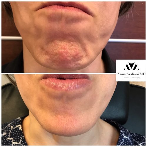 Botox Before and After - bx15