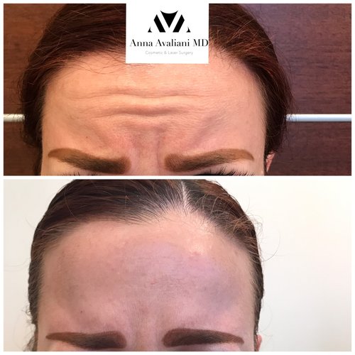 Botox Before and After - bx16