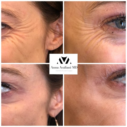 Botox Before and After - bx17