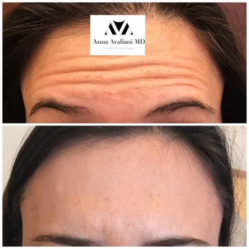 Botox Before and After - bx18