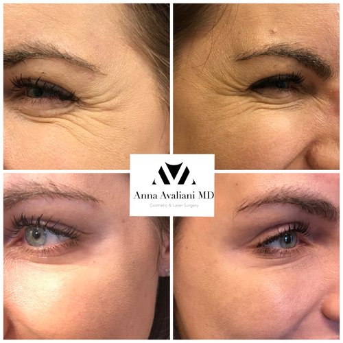 Botox Before and After - bx19