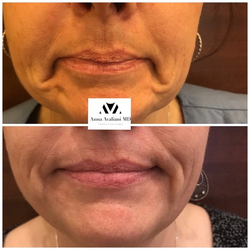 Botox Before and After - bx2