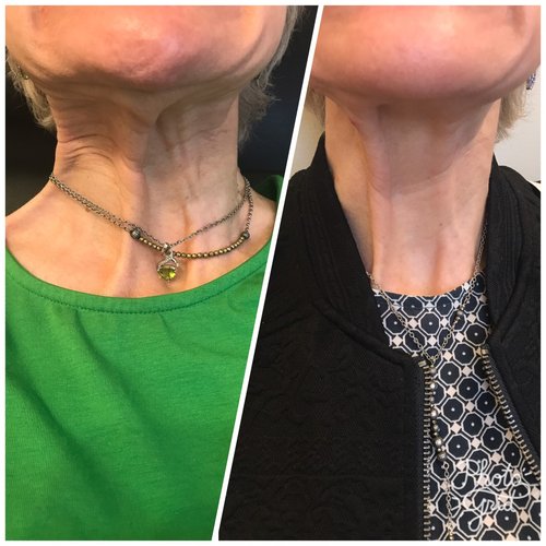 Botox Before and After - bx20