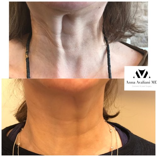 Botox Before and After - bx21