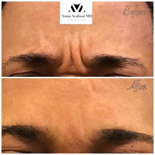 Botox Before and After - bx24