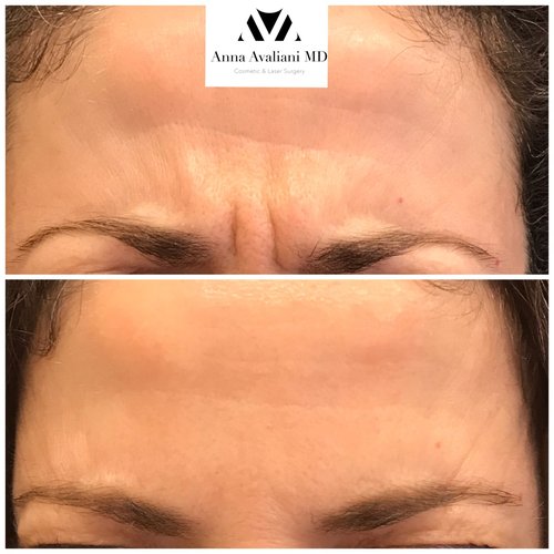 Botox Before and After - bx3