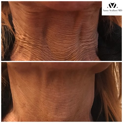 Botox Before and After - bx4