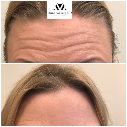 Botox Before and After - bx5