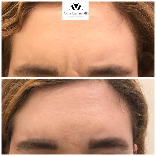 Botox Before and After - bx6