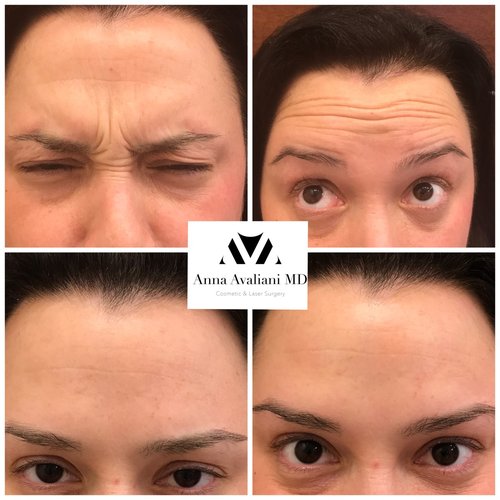 Botox Before and After - bx7