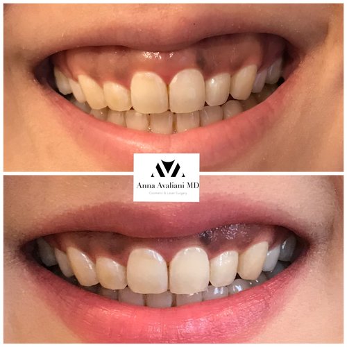 Botox Before and After - bx8