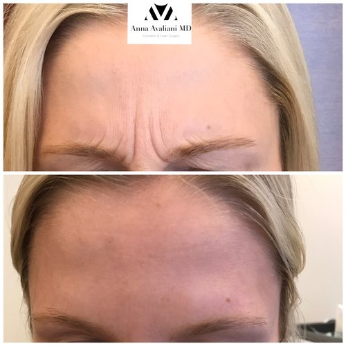 Botox Before and After - bx9