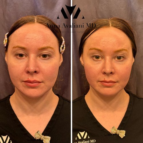 EmFace Before and After - emface2